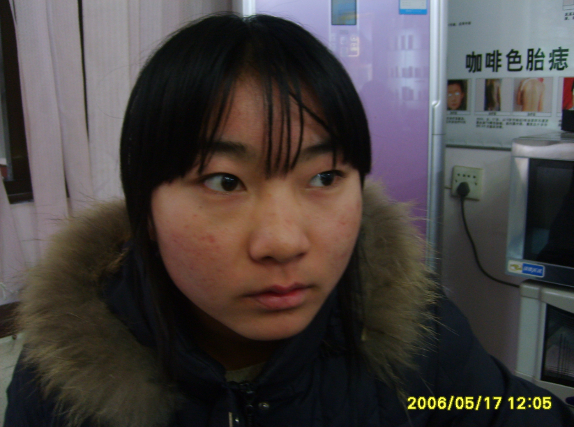 成都祛痘哪家口碑好|祛痘價格