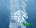 长安腰椎滑脱——品牌好的骨病专科在哪里