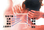 石家庄椎动脉型颈椎病 最强的骨病专科推荐