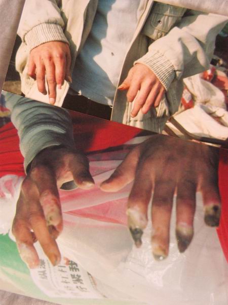 王继常脉管炎中医专科上哪买比较好|专业的脉管炎中医