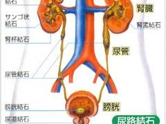 专业可靠的体外碎石治疗——龙岩尿道结石
