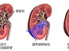 体外碎石治疗优选曙光 岛内尿道管结石