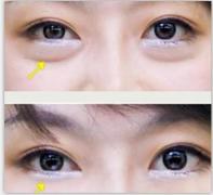 安徽精湛的祛眼袋推荐——阜阳祛眼袋手术哪家好