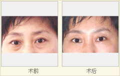 阜南祛眼袋|安徽可信赖的祛眼袋