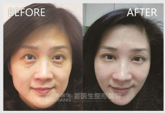 專業的開眼角|口碑好的祛眼袋