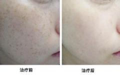 蘭州有品質的面部祛斑【薦】:面部祛斑
